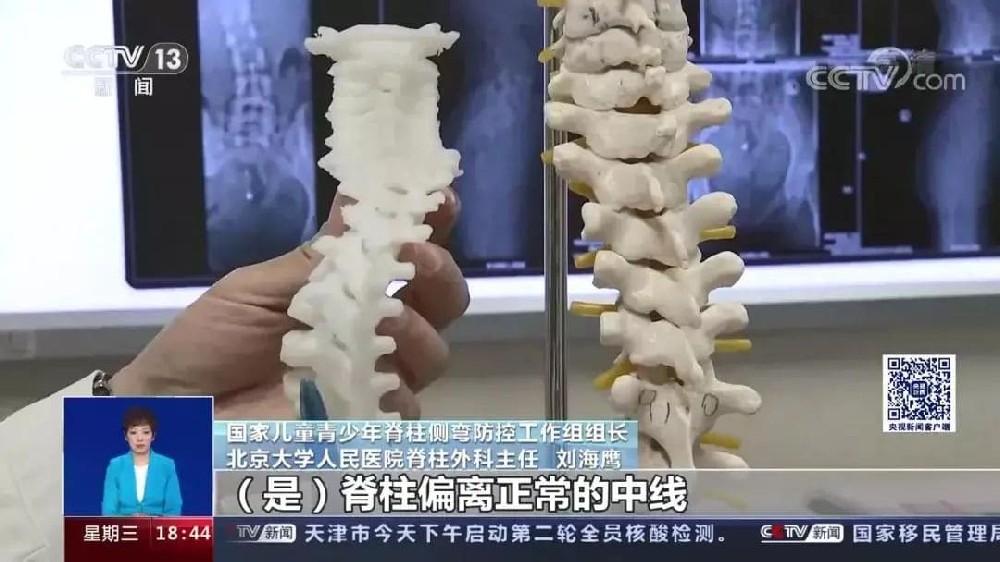 脊柱侧弯到底有多可怕？现在注意还来得及