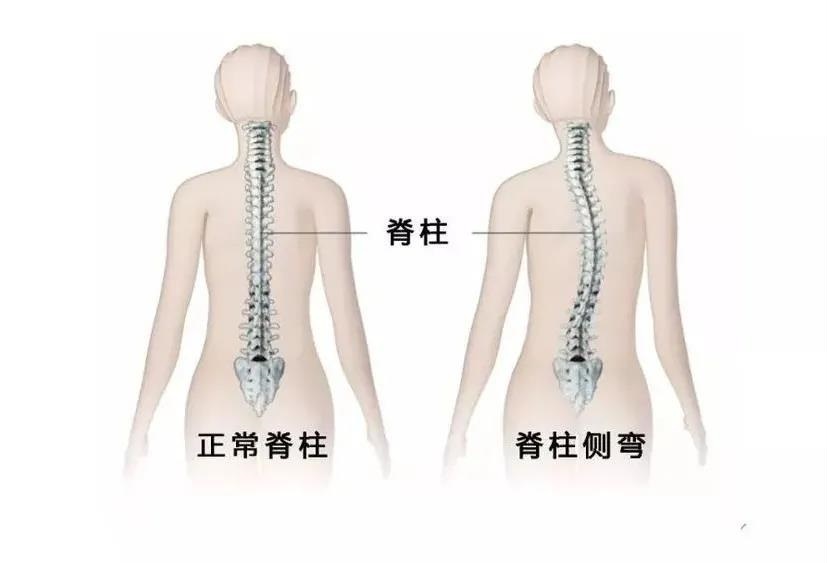 佩戴脊柱侧弯支具需要注意哪些？